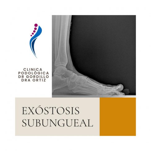 TRATAMIENTO QUIRRGICO DE EXOSTOSIS SUBUNGUEAL