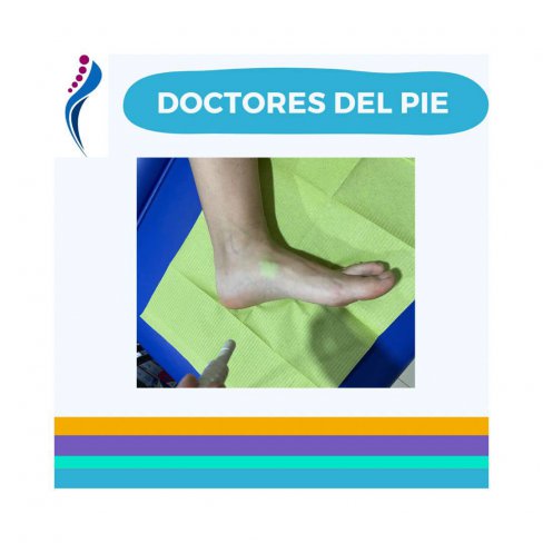 ROTURA PARCIAL DEL TIBIAL POSTERIOR