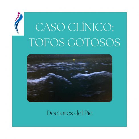 TOFOS GOTOSOS EN PRIMERA ARTICULACIN METATARSOFALNGICA