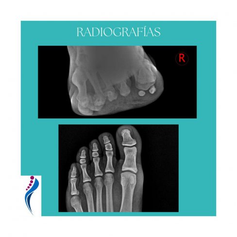 TOFOS GOTOSOS EN PRIMERA ARTICULACIÓN METATARSOFALÁNGICA