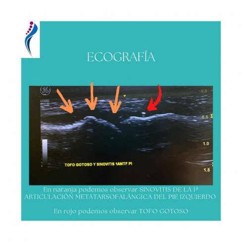 TOFOS GOTOSOS EN PRIMERA ARTICULACIÓN METATARSOFALÁNGICA