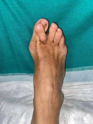 CIRUGÍA DE JUANETES (HALLUX VALGUS) Y 2º DEDO EN GARRA