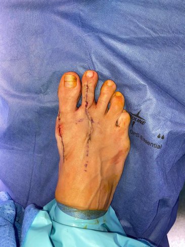 CIRUGÍA DE JUANETES (HALLUX VALGUS) Y 2º DEDO EN GARRA