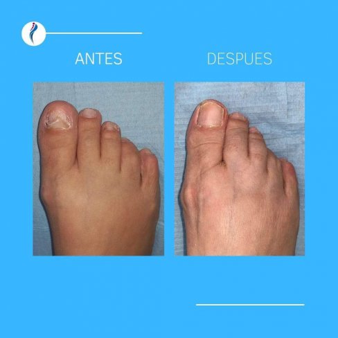 EVOLUCIÓN DE ONICOMICOSIS (HONGOS EN LAS UÑAS) DE VARIOS PACIENTES.