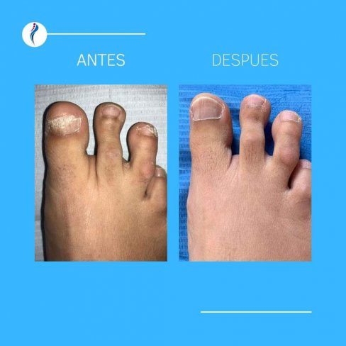 EVOLUCIÓN DE ONICOMICOSIS (HONGOS EN LAS UÑAS) DE VARIOS PACIENTES.