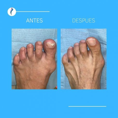 EVOLUCIÓN DE ONICOMICOSIS (HONGOS EN LAS UÑAS) DE VARIOS PACIENTES.