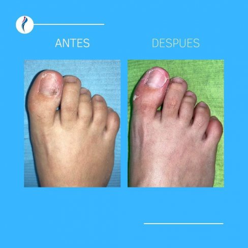 EVOLUCIÓN DE ONICOMICOSIS (HONGOS EN LAS UÑAS) DE VARIOS PACIENTES.