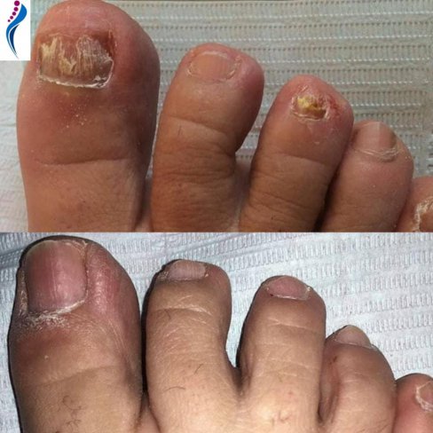 TRATAMIENTO DE HONGOS EN LAS UÑAS. ANTES Y DESPUÉS