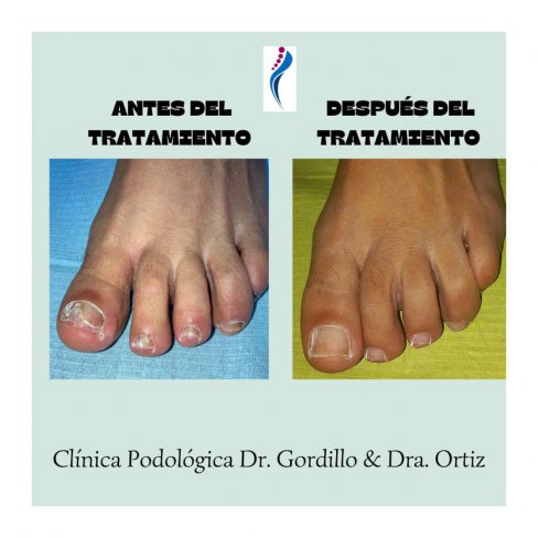 TRATAMIENTO DE HONGOS EN LAS UÑAS DE LOS PIES