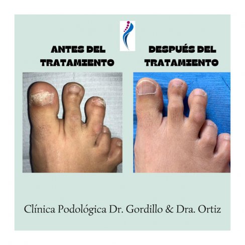 TRATAMIENTO DE HONGOS EN LAS UÑAS DE LOS PIES