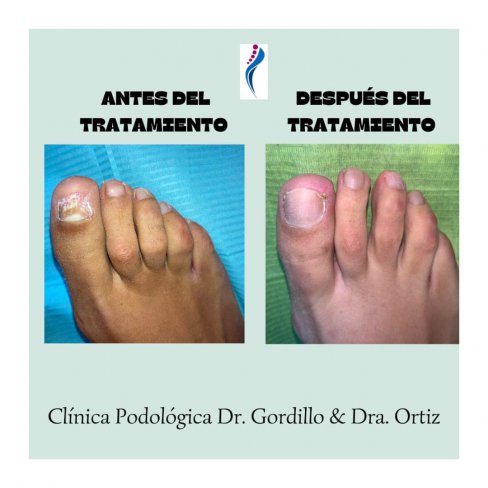 TRATAMIENTO DE HONGOS EN LAS UÑAS DE LOS PIES