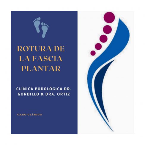 ROTURA DE LA FASCIA PLANTAR - CASO CLÍNICO