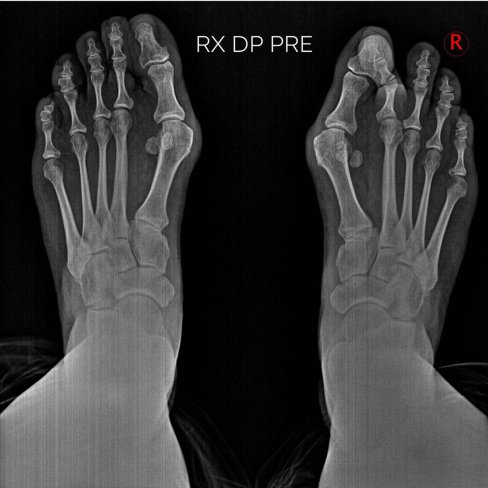 CIRUGÍA DE JUANETES (HALLUX VALGUS) Y 2º DEDO EN GARRA