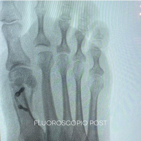 CIRUGÍA DE JUANETES (HALLUX VALGUS) Y 2º DEDO EN GARRA