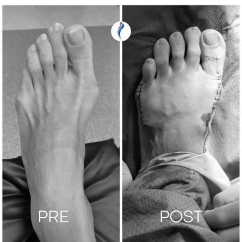 CIRUGÍA DE HALLUX VALGUS (JUANETE) Y JUANETE DE SASTRE