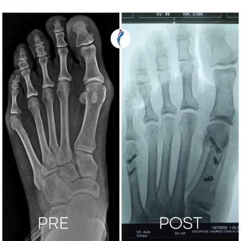 CIRUGÍA DE HALLUX VALGUS (JUANETE) Y JUANETE DE SASTRE