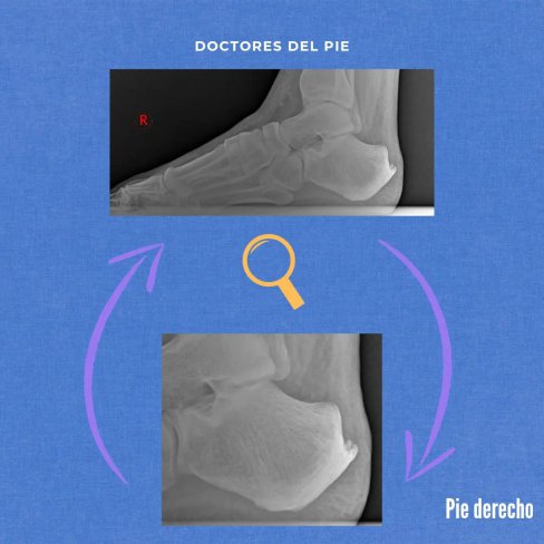 DEFORMIDAD DE HAGLUND - CASO CLÍNICO