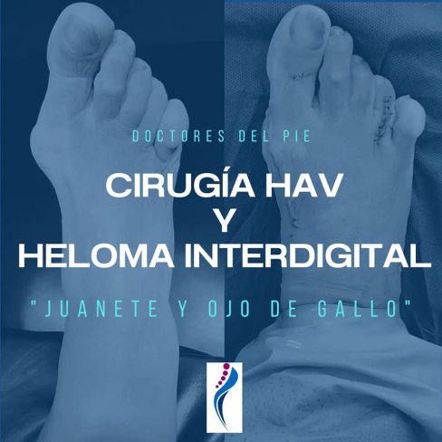 HALLUX VALGUS (JUANETE) Y HELOMA INTERDIGITAL