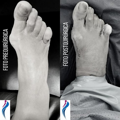 HALLUX VALGUS (JUANETE) Y HELOMA INTERDIGITAL