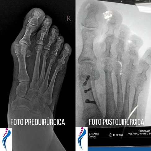 HALLUX VALGUS (JUANETE) Y HELOMA INTERDIGITAL