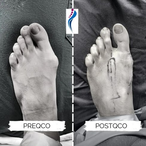 CIRUGÍA DE JUANETE (HALLUX VALGUS) EN PACIENTE JÓVEN