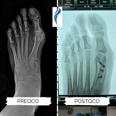 CIRUGÍA DE JUANETE (HALLUX VALGUS) EN PACIENTE JÓVEN