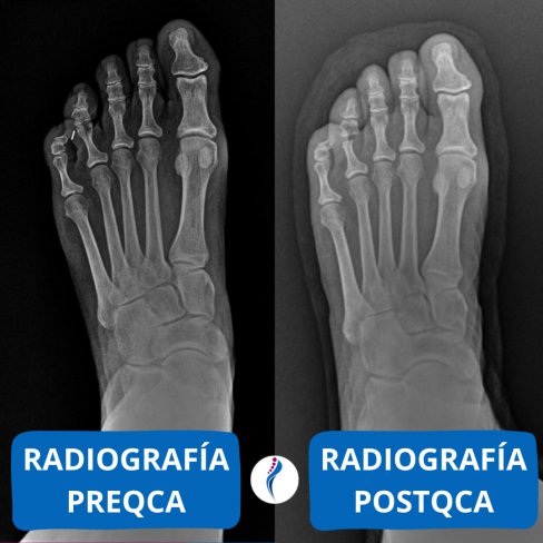 CIRUGÍA DE HELOMA INTERDIGITAL O COMÚNMENTE CONOCIDO COMO "OJO DE GALLO"