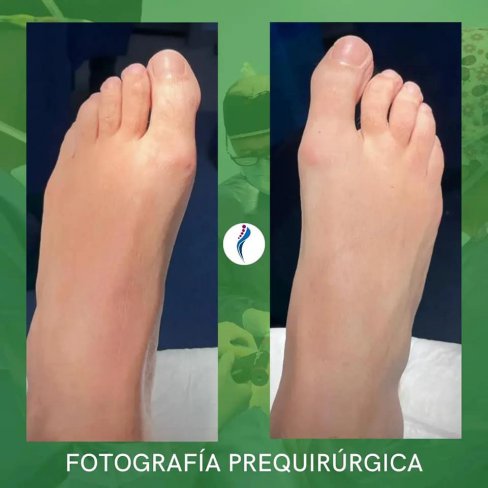 CIRUGÍA DE HALLUX RIGIDUS