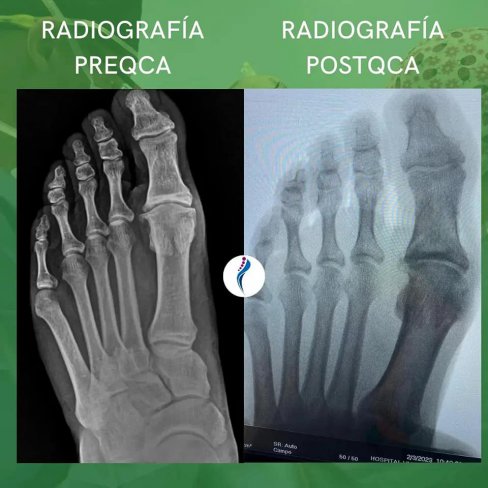 CIRUGÍA DE HALLUX RIGIDUS