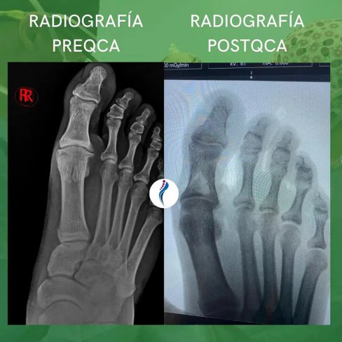 CIRUGÍA DE HALLUX RIGIDUS