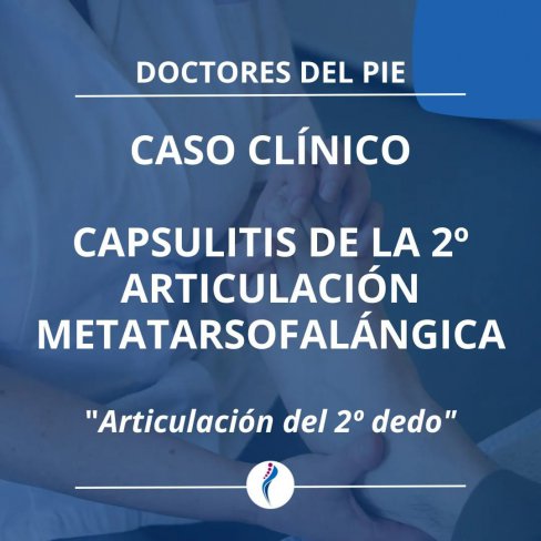 CAPSULITIS DE LA 2ª ARTICULACIÓN METATARSOFALÁNGICA