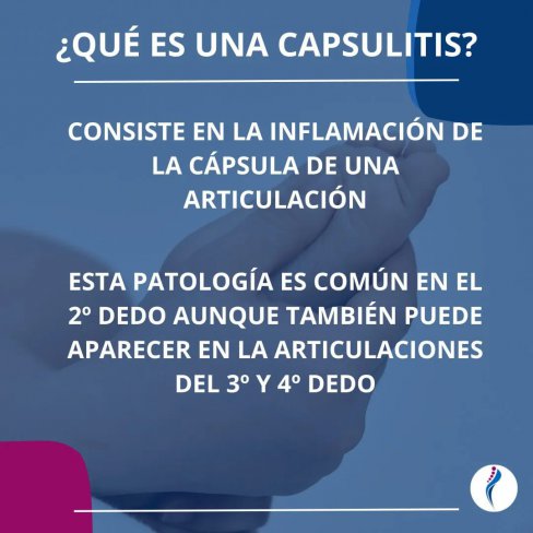 CAPSULITIS DE LA 2ª ARTICULACIÓN METATARSOFALÁNGICA