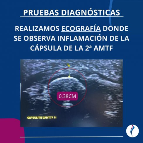 CAPSULITIS DE LA 2ª ARTICULACIÓN METATARSOFALÁNGICA