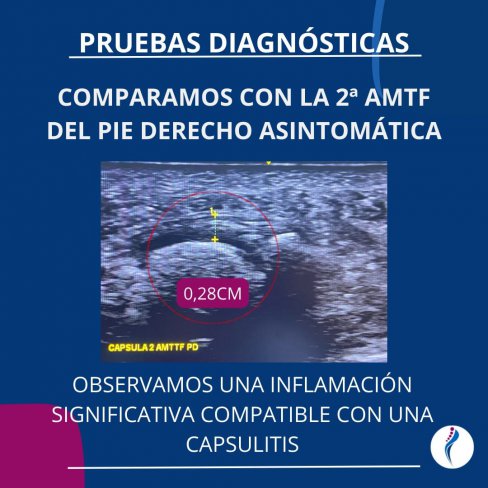 CAPSULITIS DE LA 2ª ARTICULACIÓN METATARSOFALÁNGICA