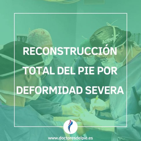 RECONSTRUCCIÓN TOTAL DEL PIE POR DEFORMIDAD SEVERA