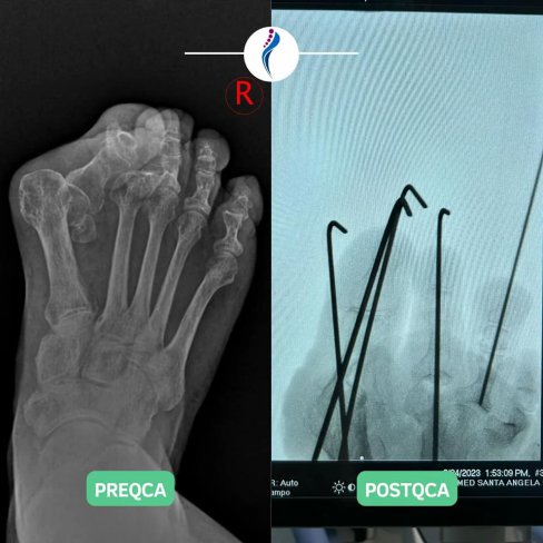RECONSTRUCCIÓN TOTAL DEL PIE POR DEFORMIDAD SEVERA