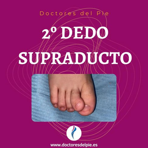 2º DEDO SUPRADUCTO