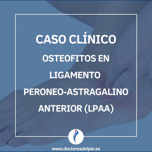 OSTEOFITOS EN LIGAMENTO PERONEO-ASTRAGALINO ANTERIOR