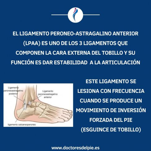 OSTEOFITOS EN LIGAMENTO PERONEO-ASTRAGALINO ANTERIOR