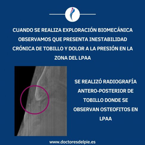 OSTEOFITOS EN LIGAMENTO PERONEO-ASTRAGALINO ANTERIOR