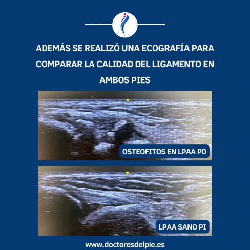 OSTEOFITOS EN LIGAMENTO PERONEO-ASTRAGALINO ANTERIOR