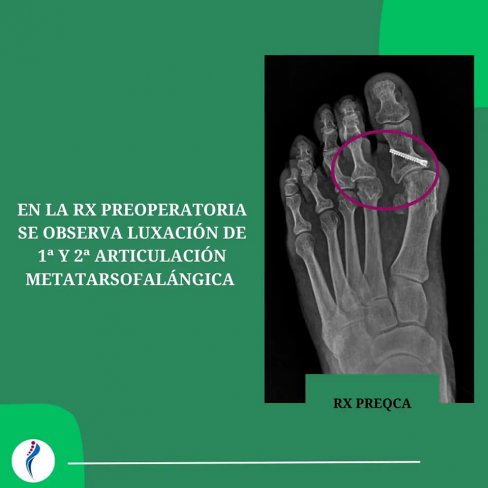 CIRUGÍA DE JUANETE (HALLUX VALGUS) IATROGÉNICO 