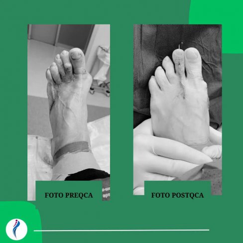 CIRUGA DE JUANETE (HALLUX VALGUS) IATROGNICO 