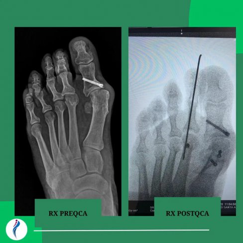 CIRUGÍA DE JUANETE (HALLUX VALGUS) IATROGÉNICO 