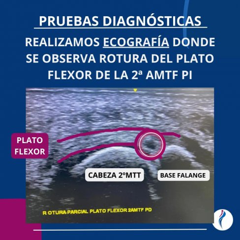 ROTURA DEL PLATO FLEXOR EN 2ª ARTICULACIÓN METATARSOFALÁNGICA (Articulación del segundo dedo)