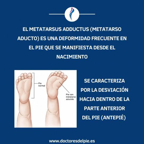 METATARSO ADUCTO - CAMINAR CON LOS PIES HACIA DENTRO