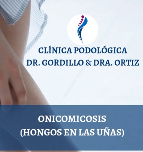 HONGOS EN LAS UÑAS DE LOS PIES