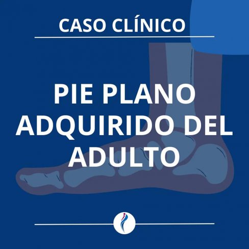 PIE PLANO VALGO ADQUIRIDO DEL ADULTO