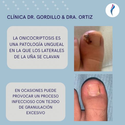 ONICOCRIPTOSIS(UÑA ENCARNADA) PRIMER DEDO BILATERAL