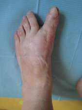 HALLUX VARUS